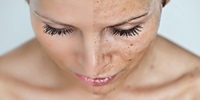 آی – پی-ال /ایلایت / اس اچ آر ipl-elight-shr