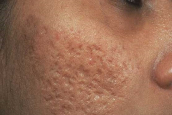 روش ميكرونيدل جهت از بين بردن جاي جوش